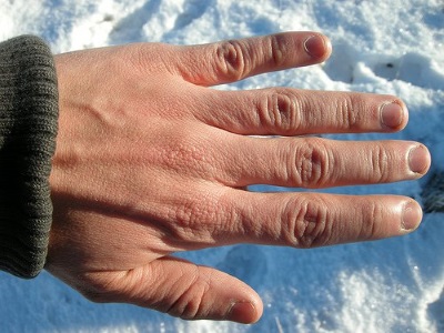 Frostbite